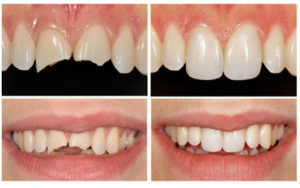 Lee más sobre el artículo Tapaduras Dentales