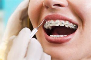 Lee más sobre el artículo Tratamiento de Ortodoncia