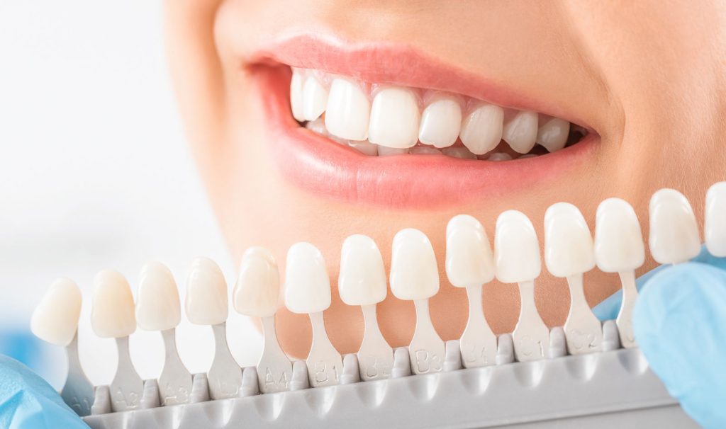 Blanqueamiento dental