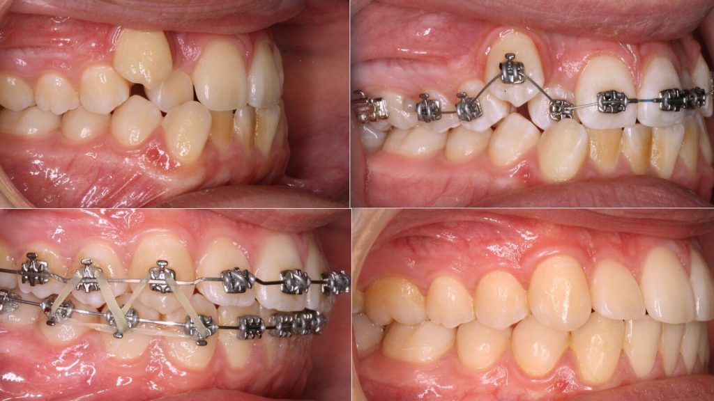 Tratamiento de Ortodoncia