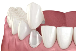 Lee más sobre el artículo Prótesis dental fija