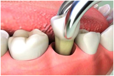 Extracción dental