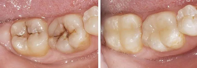 Tapaduras dentales