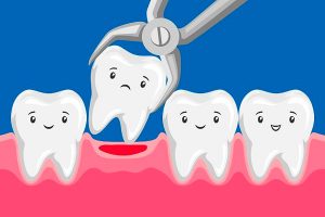 Extracción dental blog
