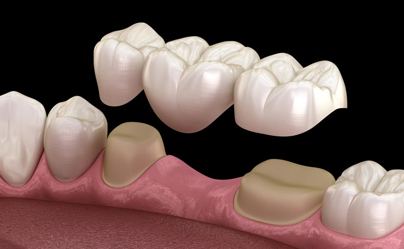 Prótesis dental fija