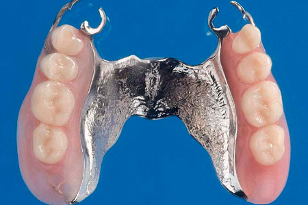 Prótesis dental