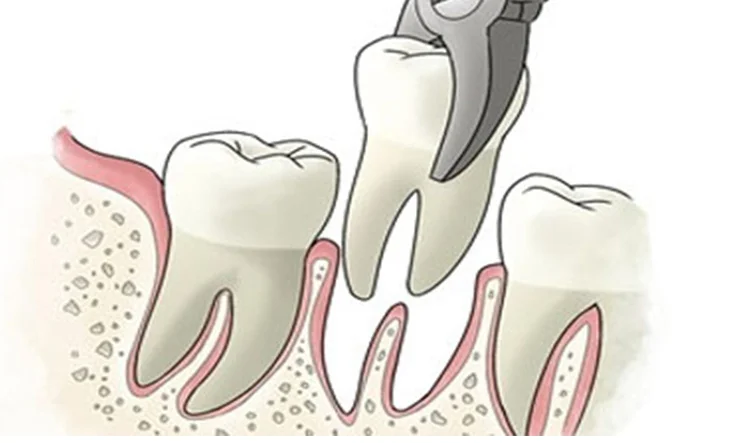 Extracción dental
