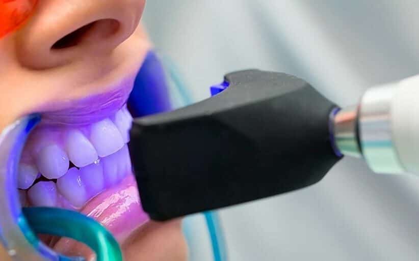Blanqueamiento dental