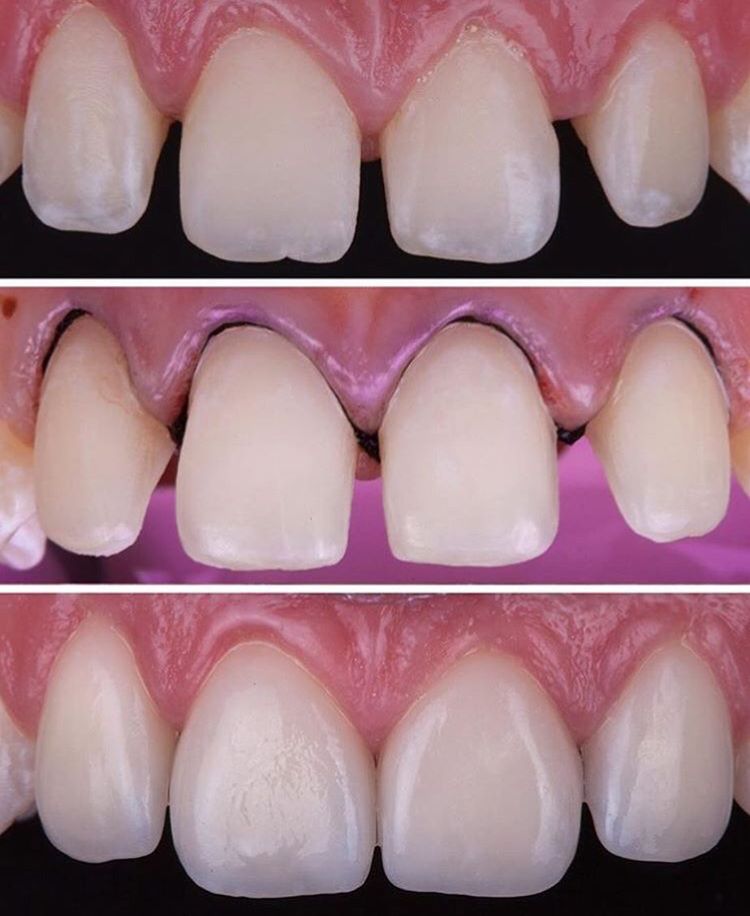 Corona dental