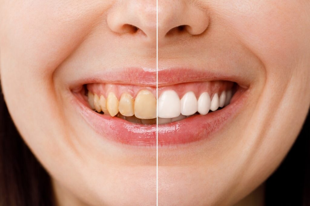 Blanqueamiento dental