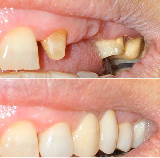 Corona dental