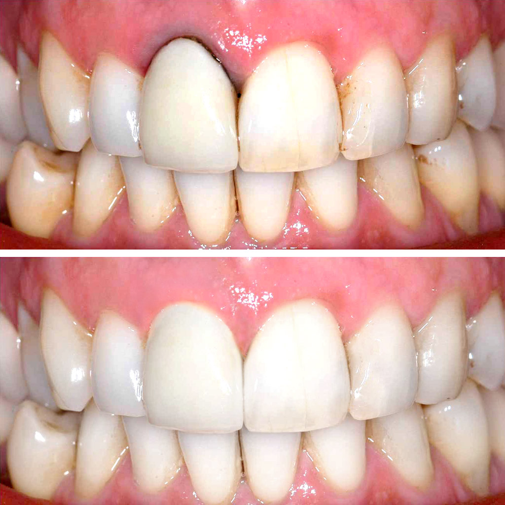 Corona dental