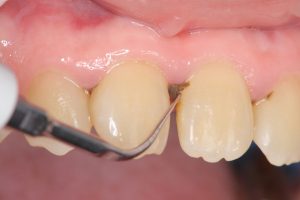 Destartraje dental