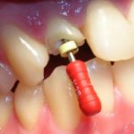 Endodoncia