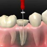Endodoncia