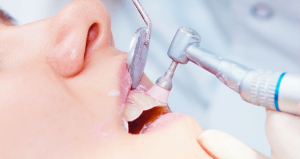 Destartraje dental