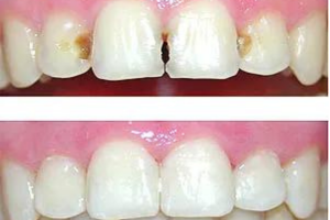 Tapadura dental