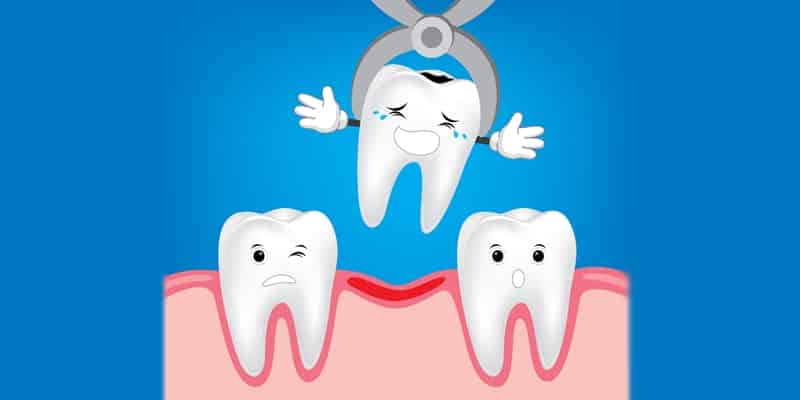 Extracción dental