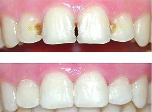 Tapaduras de dientes